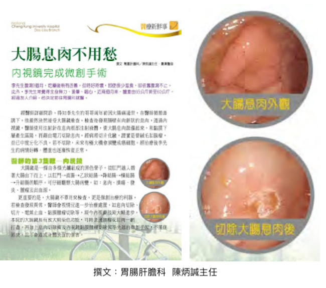 大腸息肉 不用愁